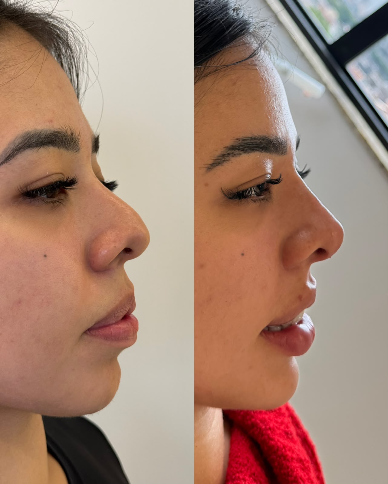 Antes e depois de perfiloplastia — perfil com nariz e lábios harmonizados
