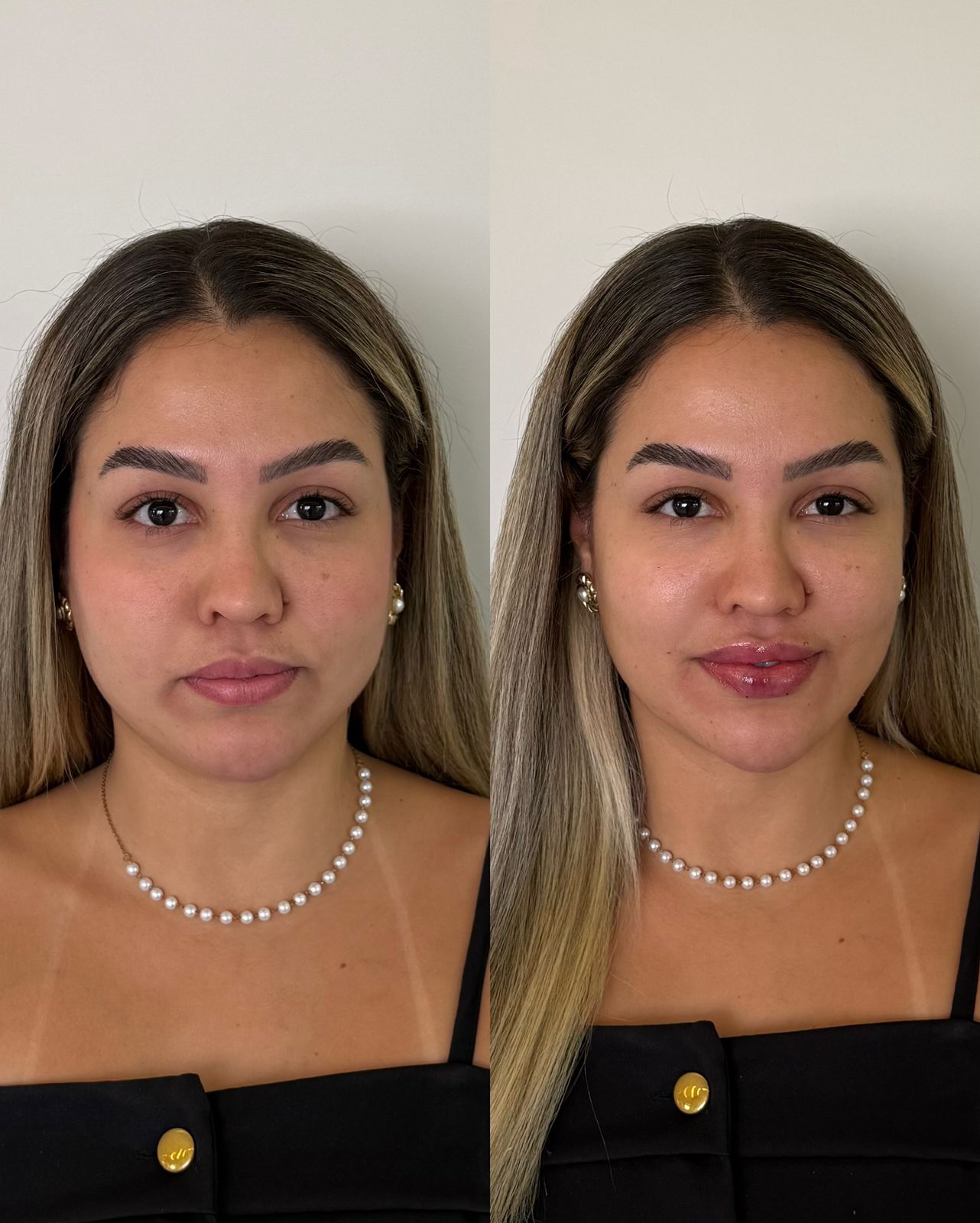 Antes e depois de preenchimento labial — vista frontal