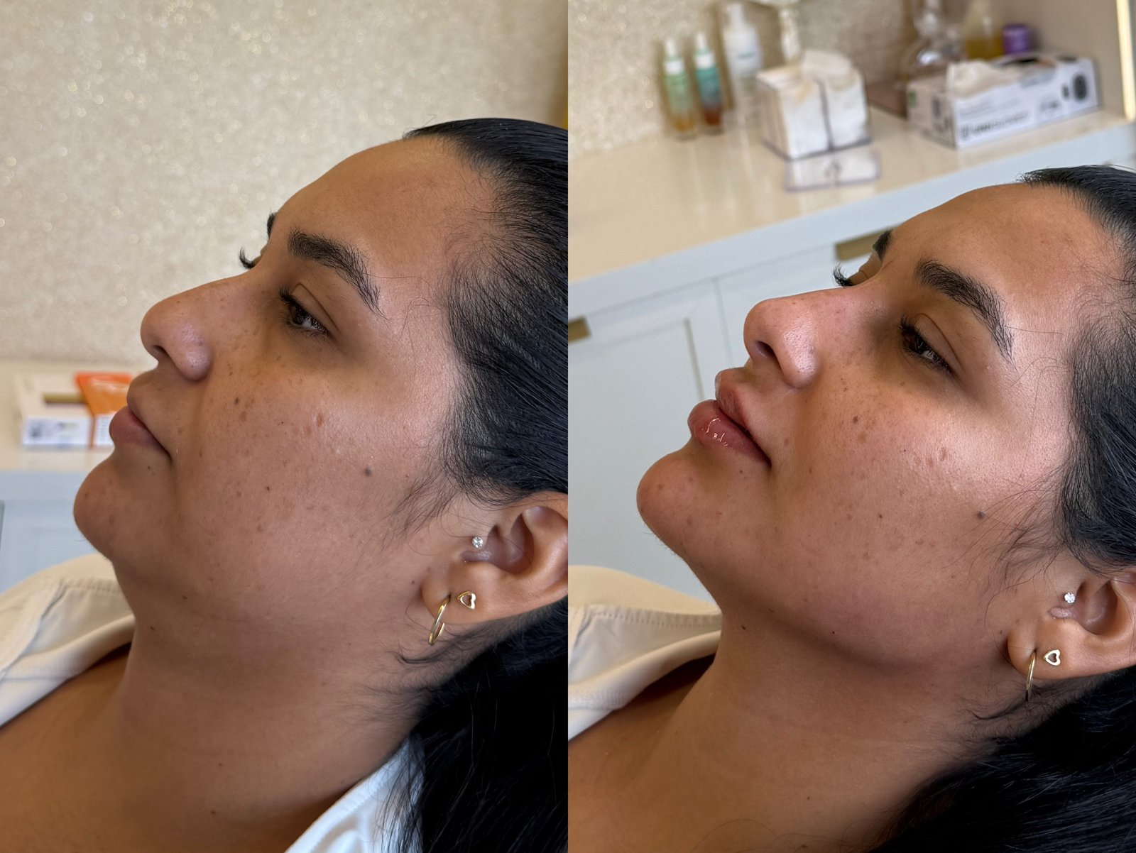 Antes e depois — perfil com lábios e mento harmonizados