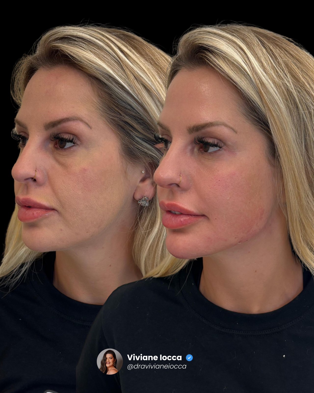 Antes e depois — rosto em três quartos com lábios e mandíbula harmonizados