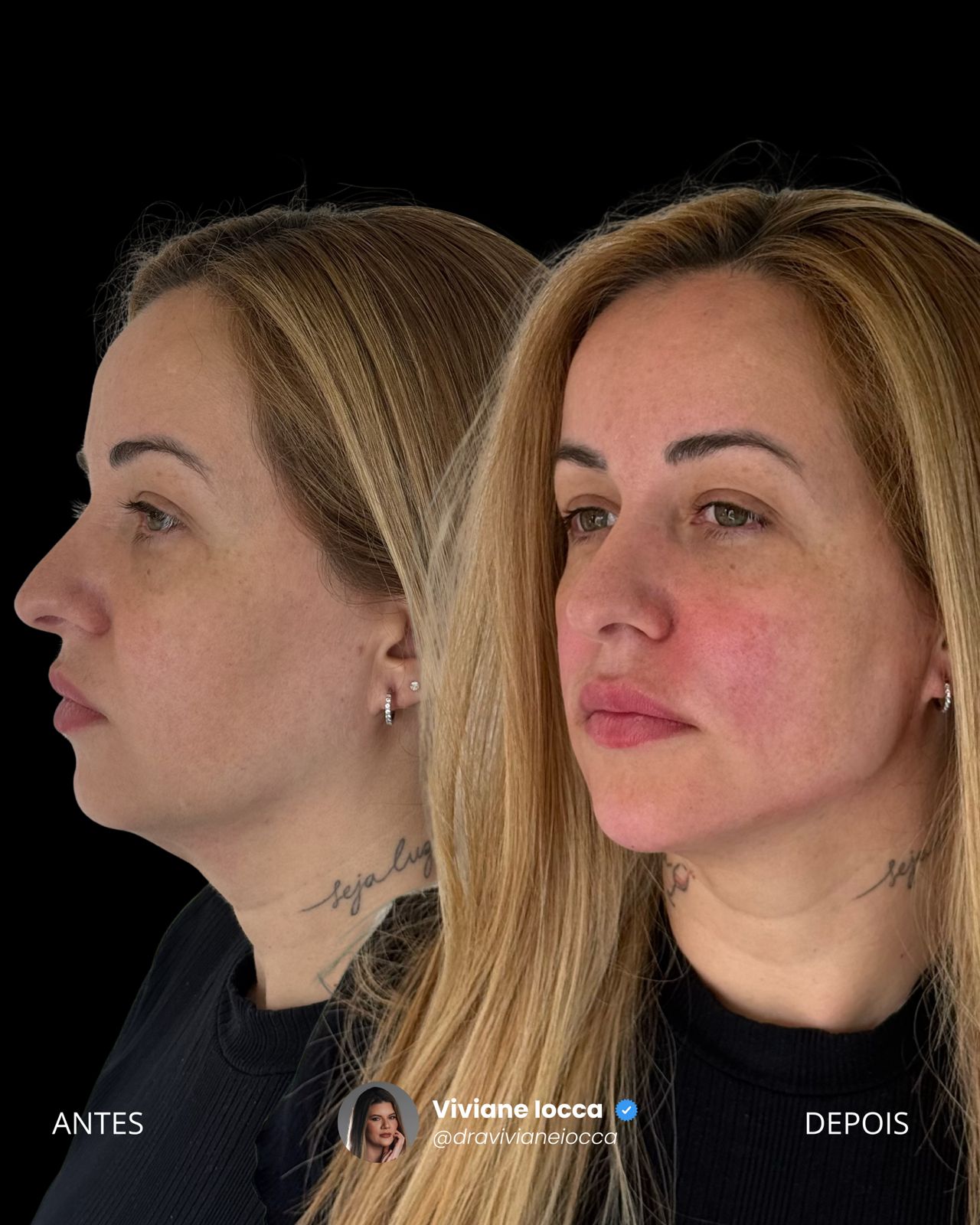 Antes e depois de perfiloplastia — perfil com nariz, lábios, mento e mandíbula harmonizados