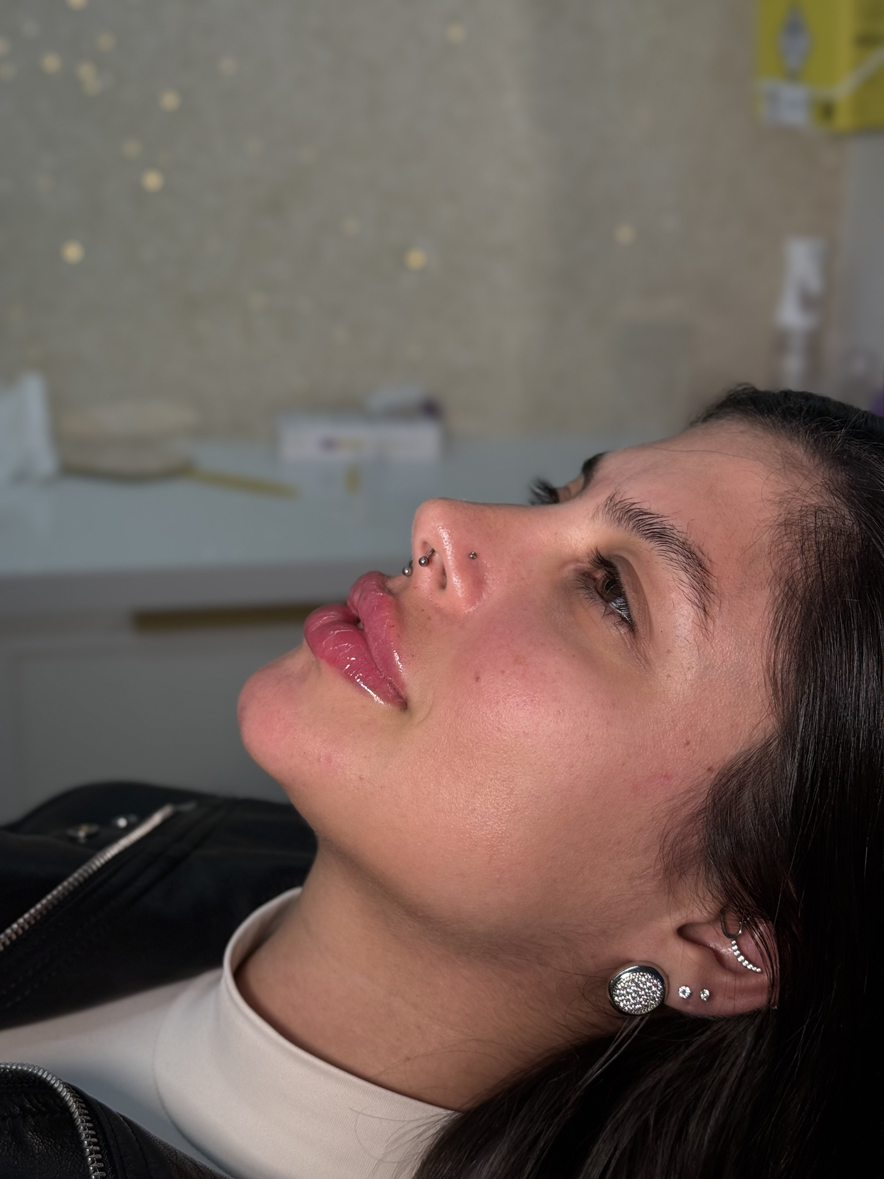 Resultado de preenchimento labial em paciente reclinada na clínica